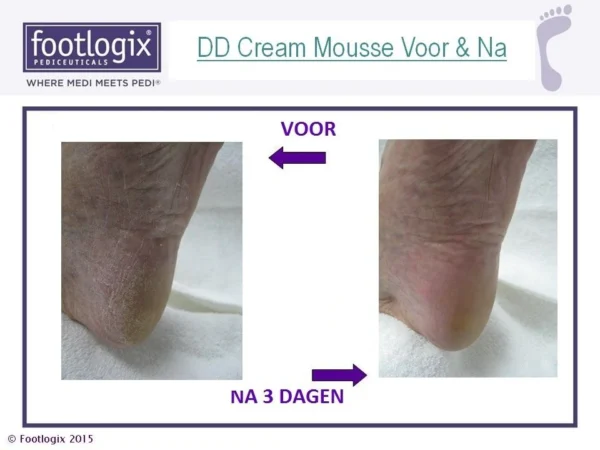 Footlogix "DD CREAM MOUSSE" double defense cream mousse voor droge, gebarsten huid en eelt - Afbeelding 2