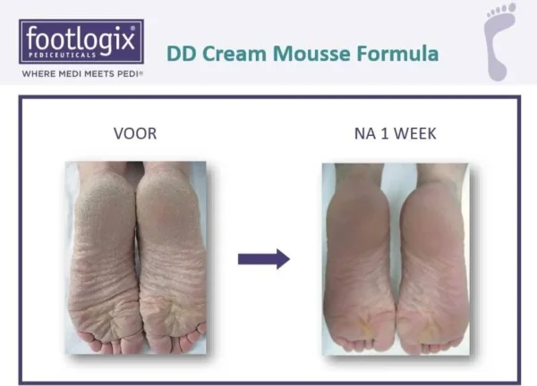 Footlogix "DD CREAM MOUSSE" double defense cream mousse voor droge, gebarsten huid en eelt - Afbeelding 3
